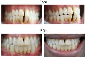 Före och efterbilder på ett leende där tänderna tidigare rört sig utåt