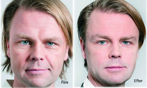 Manligt ansikt före och efter behandling med Stylage fillers
