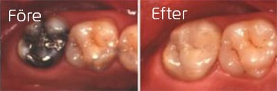 Före och efterbilder på amalgam lagad tand ersatt med porslinsfyllning