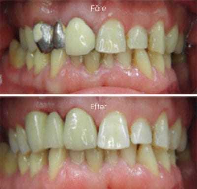 Före och efterbild, där förebilden visar två tänder lagade med metal och efterbilden visar vita tänder