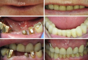 Före och efterbild på hel tandbro i underkäke, tandkronor och tandprotes i överkäke