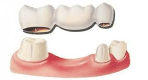 illustration på tandbrygga