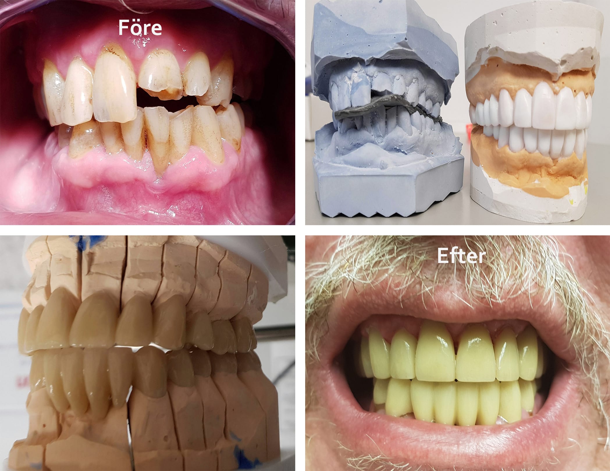 tandläkare Haninge Före och efter bilder på tänder som blivit fixade