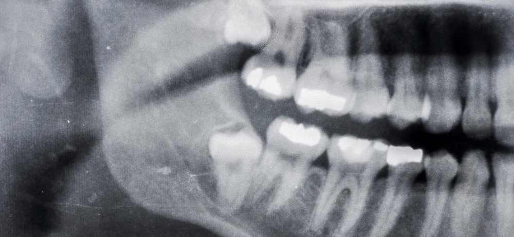 visdomstand som växer fel visdomstand som växer fel